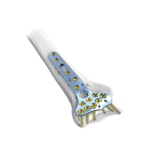Placca di compressione per radio - Rim  - NORMMED Medical Devices - distale / bloccata / in metallo