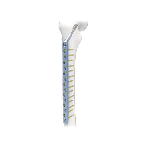 Placca di compressione per femore - PNM1024 - NORMMED Medical Devices - bloccata / in metallo