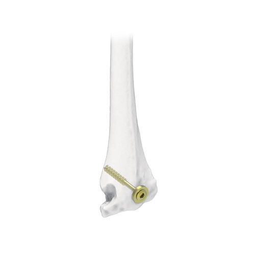 Vite per compressione ossea per omero - NORMMED Medical Devices - canalare / in metallo