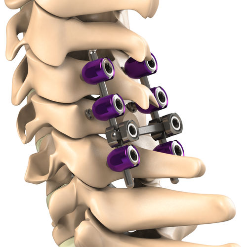 Sistema di osteosintesi cervicale - PCS - Aditus Medical - via posteriore / per adulti