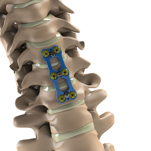 Placca per artrodesi cervicale - Tİ-6Al-4V ELI  - Aditus Medical - bloccata / in metallo / 2 livelli
