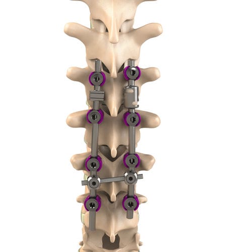 Sistema di osteosintesi toraco-lombare - Aditus Medical - via posteriore / per adulti