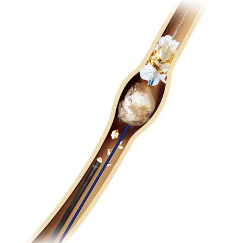 Catetere per estrazione di calcoli - Innovex Medical - ureterale / con rivestimento idrofilico