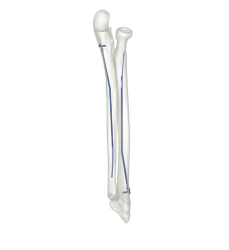 Chiodo intramidollare per radio - 83527 series - Peditst - per ulna / in titanio