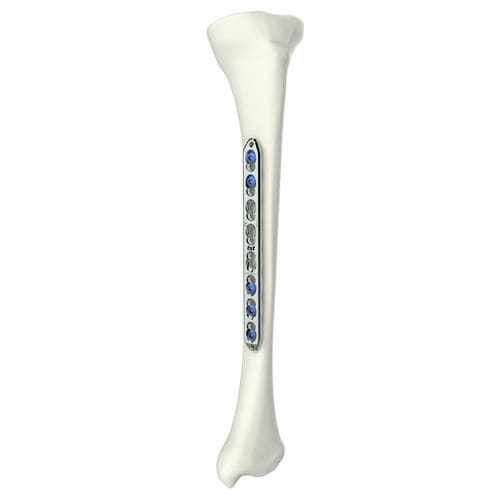 Placca di compressione per omero - 317270000 series - Peditst - per tibia / bloccata / in titanio