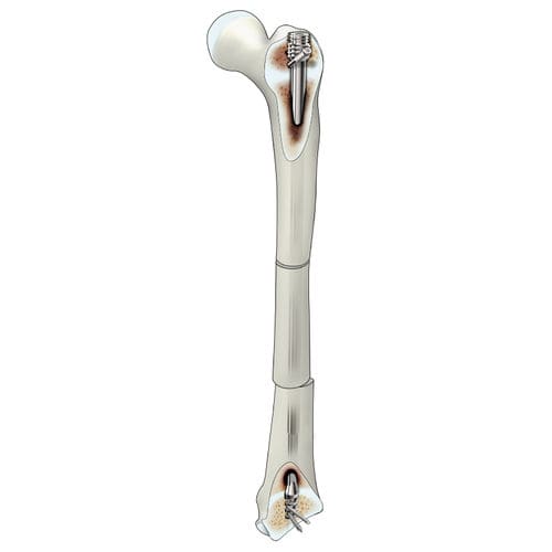 Chiodo intramidollare per femore - D-SCOPE - Peditst - fissazione prossimale / fissazione distale / pediatrico