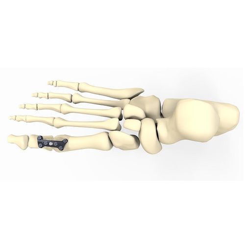 Placca per artrodesi per alluce valgo - FRC20 series - Aleda Medical - bloccata / in metallo