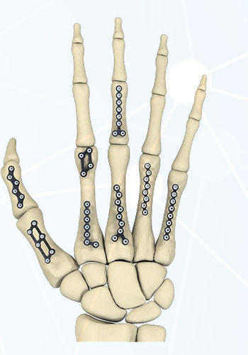 Placca di compressione per falange della mano - FRC series - Aleda Medical - per metacarpo / bloccata / in metallo