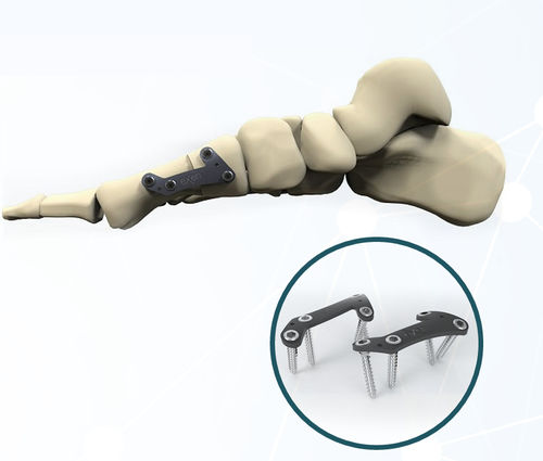 Placca per artrodesi per alluce valgo - FRC200 series - Aleda Medical - bloccata / in metallo