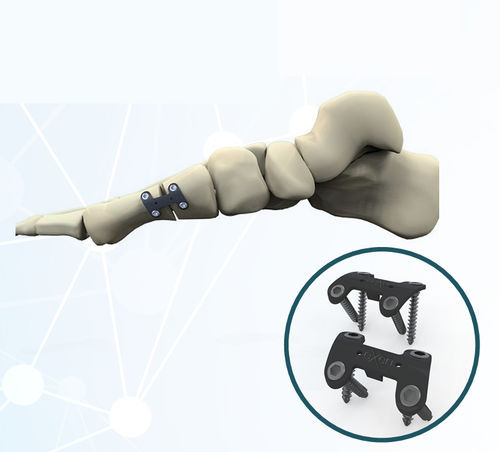 Placca per artrodesi per alluce valgo - FRC20 series - Aleda Medical - bloccata / in metallo