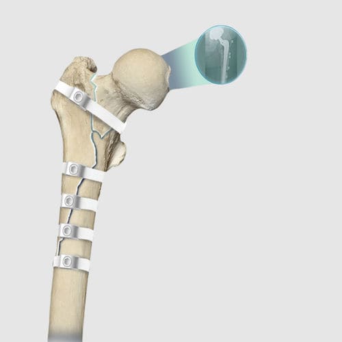 Filo per cerchiaggio ortopedico per revisione di protesi dell'anca - Ortholox® UHMWPE - Ortolog Medikal - multifilamento polimerico