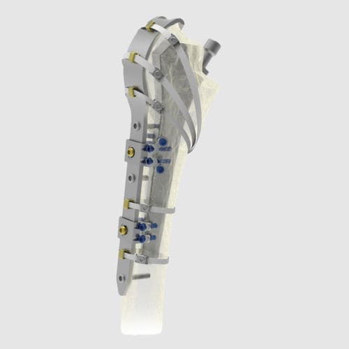 Placca di compressione per frattura femorale periprotesica - Ortholox®  - Ortolog Medikal - prossimale / bloccata / in titanio