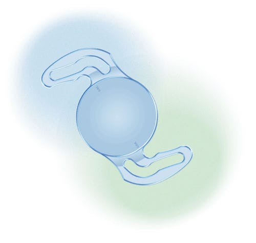 Lente intraoculare torica - EVToric - Aurolab - per astigmatismo