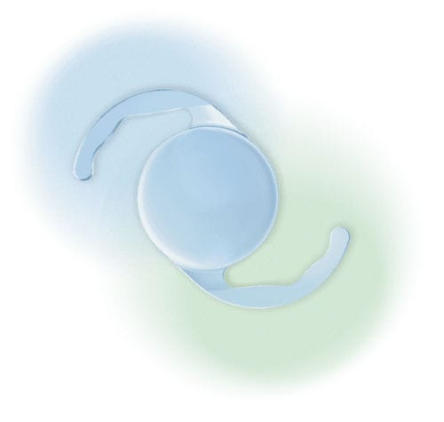 Lente intraoculare monofocale - Evpl - Aurolab