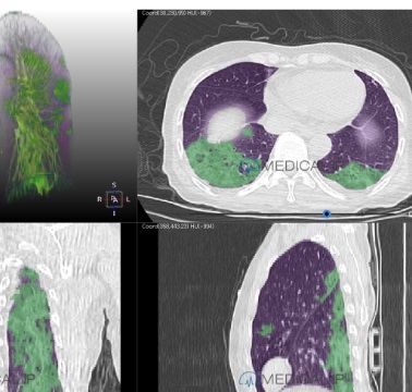 Software di analisi delle immagini - MEDIP Pneumovid - MEDICALIP Co., Ltd. - di visualizzazione / con sistema di tracciatura / per tomografia computerizzata
