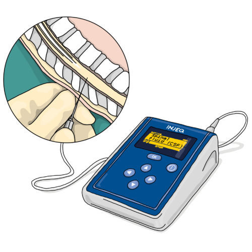 Analizzatore di chimica clinica del liquido cerebrospinale - Injeq IQ-Tip® - Injeq Ltd. - automatico / da banco