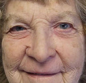 Protesi estetica nasale - Medical Art Prosthetics - per adulti