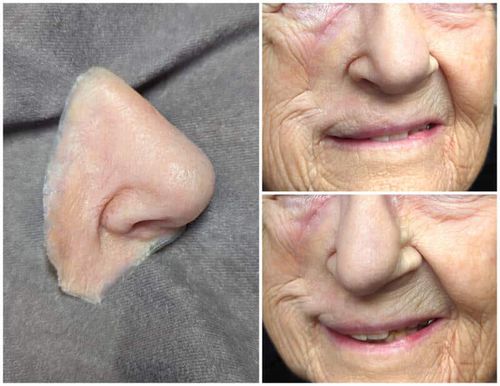 Protesi estetica nasale - lifelike  - Medical Art Prosthetics - per adulti