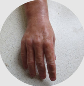 Protesi estetica mano - myo-electric - Northern Prosthetics - per adulti