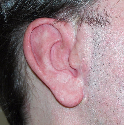 Protesi estetica padiglione auricolare - Prosthetic Illusions - per adulti