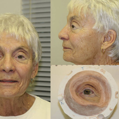 Protesi estetica orbitale - Prosthetic Artists - per adulti