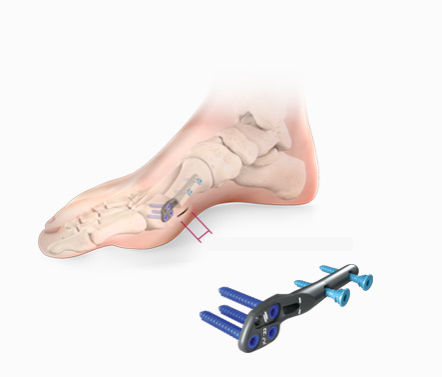 Placca per osteotomia per alluce valgo - Centrolock® - novastep - laterale / bloccata / in metallo