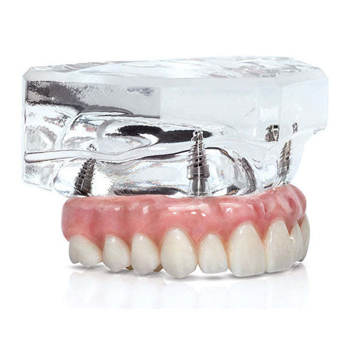 Modello anatomico di bocca - BruxZir&reg; - Glidewell Direct - di denti / di dentatura / di mandibola