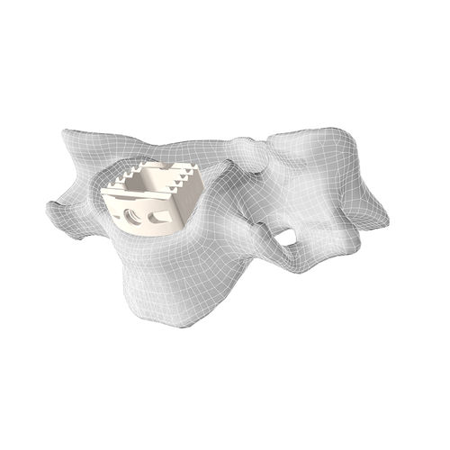 Gabbia intersomatica cervicale - CL5™ - Corelink Surgical - via anteriore / in PEEK