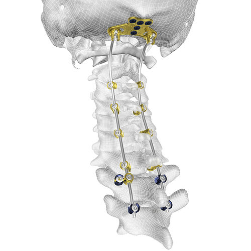 Sistema di osteosintesi occipito-cervico-toracico - TIGER® - Corelink Surgical - via posteriore / per adulti