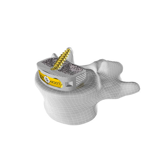 Gabbia intersomatica lombare - M3 STAND-ALONE ALIF - Corelink Surgical - via anteriore