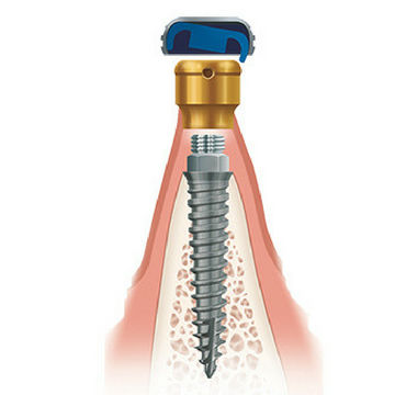 Impianto dentale in titanio - Zest Dental Solutions - anatomico / stretto / di ancoraggio ortodontico