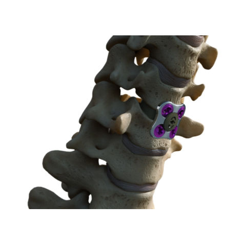 Placca per artrodesi cervicale - SETx  - Xenco Medical - in metallo / 1 livello