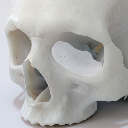 Impianto periorbitale su misura - TnR series - T&R Biofab - assorbibile