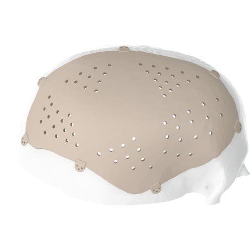Impianto cranico su misura - Kune Implants