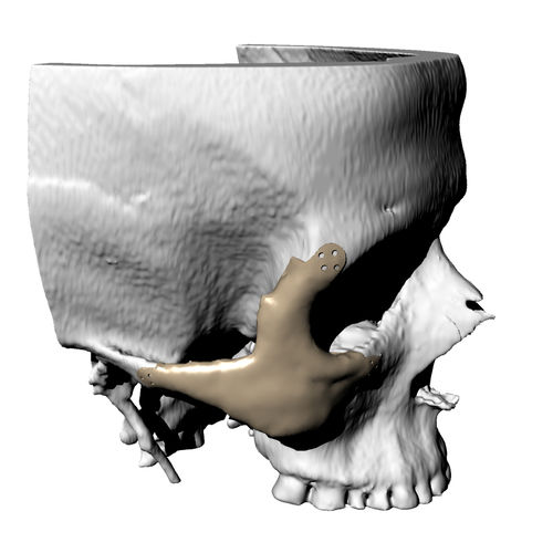 Impianto periorbitale su misura - Kune Implants - non assorbibile