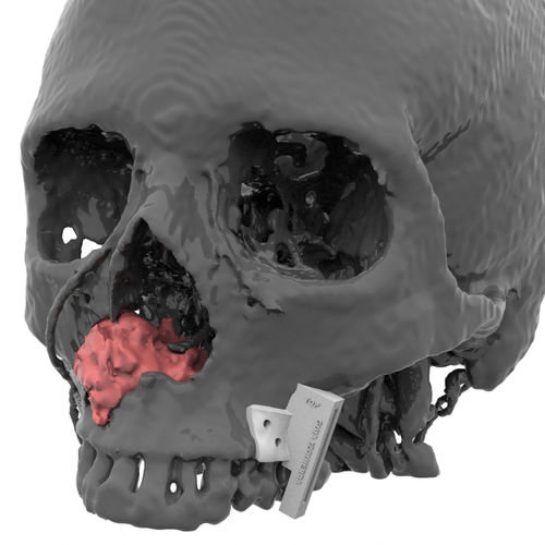 Dima di resezione per ricostruzione maxillo-facciale - Kune Implants