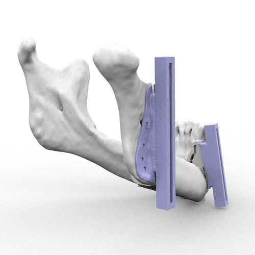 Dima di resezione per ricostruzione maxillo-facciale - RMP - Kune Implants