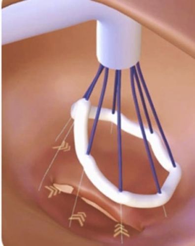 Sistema di riparazione cardiaca valvola mitrale - Valfix Medical - per valvola tricuspide