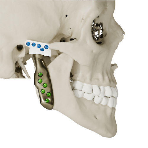 Impianto temporo-mandibolare su misura - Craniotech