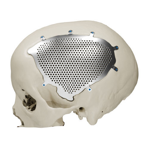 Impianto cranico su misura - Craniotech