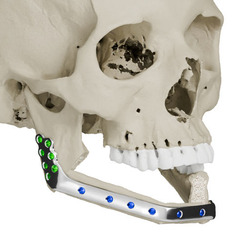 Impianto mandibolare su misura - Craniotech - non assorbibile