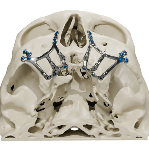 Impianto sottoperiosteo su misura - Craniotech - in titanio / anatomico / subperiostale