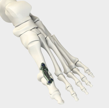 Placca per artrodesi per articolazione metatarso-falangea - DynaFORCE® MPJ  - CrossRoads Extremity Systems - in metallo