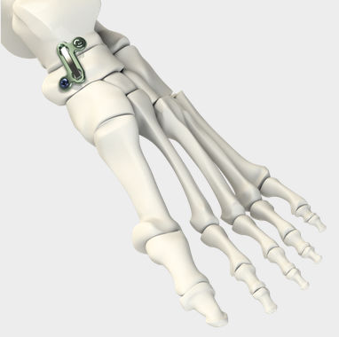 Placca per artrodesi per articolazione talonavicolare - DynaFORCE® T/N FUSION - CrossRoads Extremity Systems - in metallo