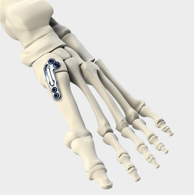 Placca per artrodesi per articolazione tarso-metatarsica - LAPIDUS - CrossRoads Extremity Systems - in metallo