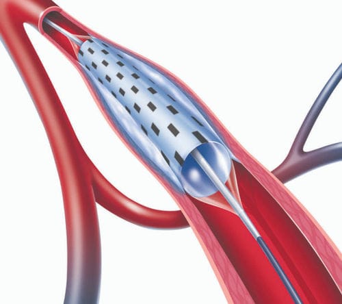 Catetere PTA - PolarCath  - Nucryo Vascular - per arteria sottopoplitea / per arteria femorale / per arteria iliaca