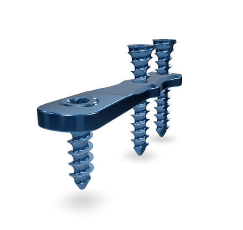 Placca di compressione per alluce valgo - HV 2.7 - Astrolabe - bloccata / in titanio