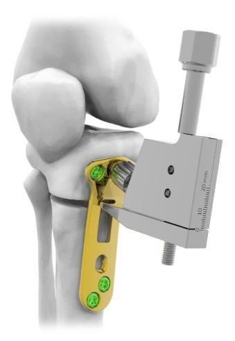 placca per osteotomia per tibia - Astrolabe