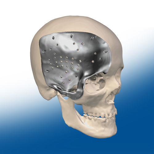 Impianto cranico su misura - Ortho Baltic
