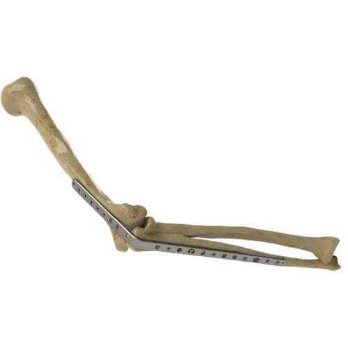 Placca per artrodesi per gomito - 1222-0010 - Zimed Medical - bloccata / in metallo